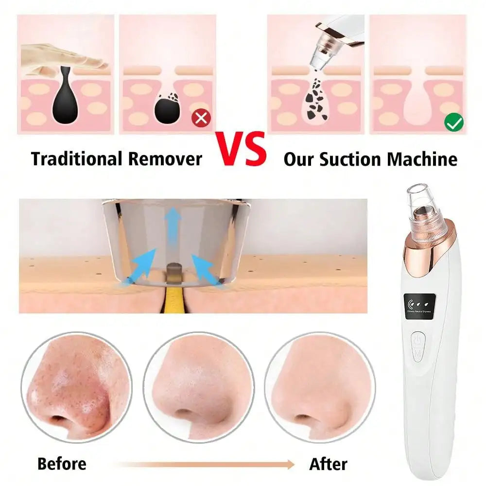 5 in 1 BLACK HEADS ACNE OIL REMOVER